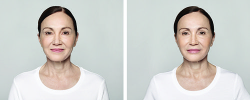 Restylane Family Lyft Silk Sculptra before and after photos