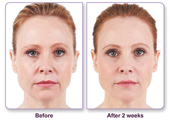 Before and after Juvederm