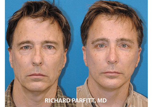 Facelift Male Dr. Parfitt