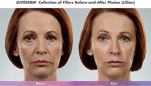 Juvederm Collection Before After Photos