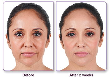 Juvederm before and after patient