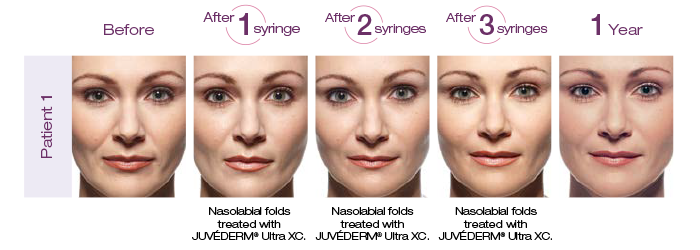 Juvederm patient before and after