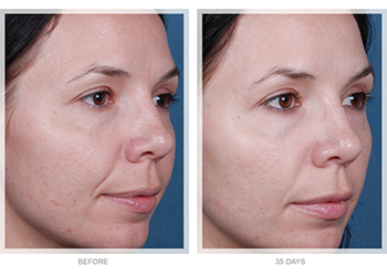 chemical peels before and after women of color