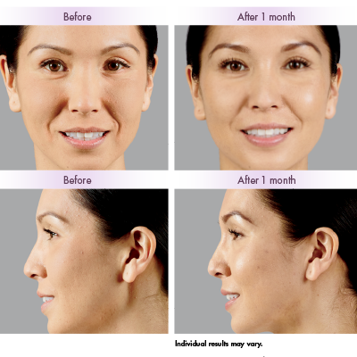 Juvederm Voluma before and after