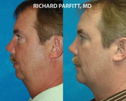 chin implant Madison WI patient