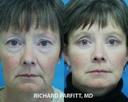 woman facelift surgery Madison Wisconsin