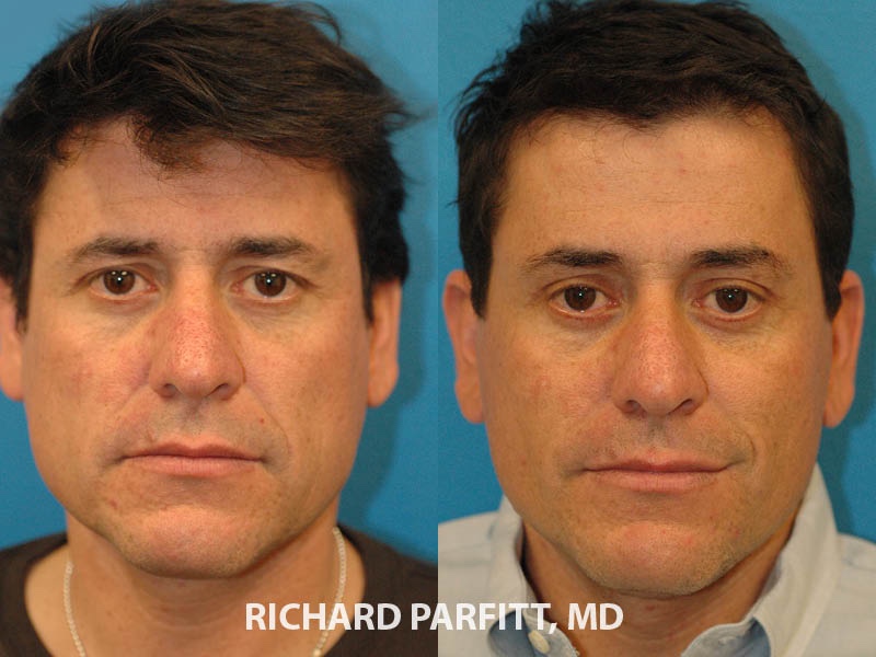 Facial Plastic Surgery - AestheticA Skin Health Center