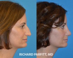 rhinoplasty nose job Madison Wisconsin