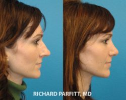rhinoplasty nose job WI patient