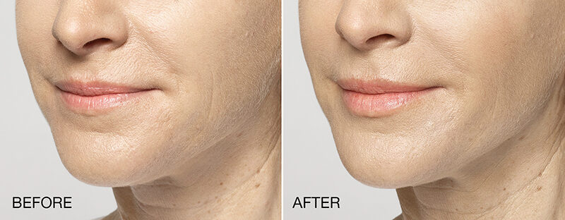 Restylane Silk Before and After Photos Lips Perioral Lines