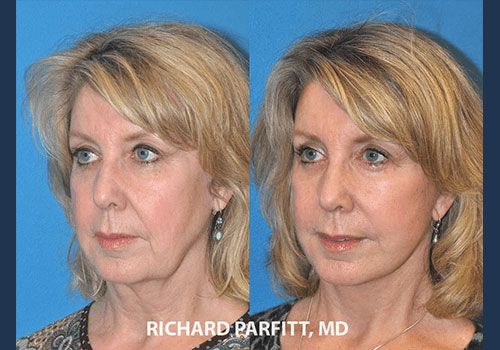 Woman Facelift Dr. Parfitt Madison WI