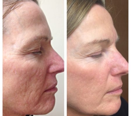 The Microneedling Rundown With Before and After Photos – Perfect Face  Aesthetic Medicine