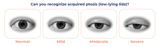 Acquired Ptosis low-lying eyelids