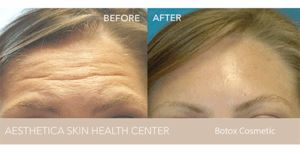 AestheticA Botox Patient