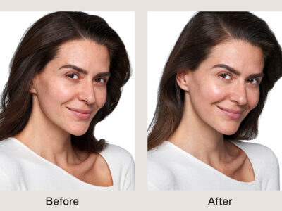 SKINVIVE Patient Courtesy of Allergan