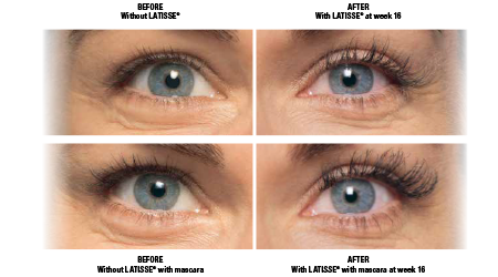 Latisse Before After