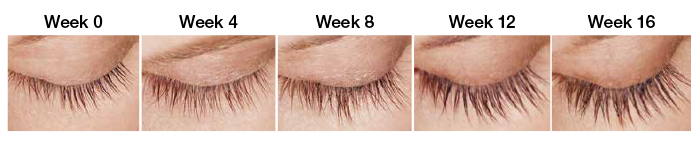 Latisse Progression