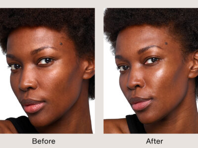 SKINVIVE Patient Courtesy of Allergan